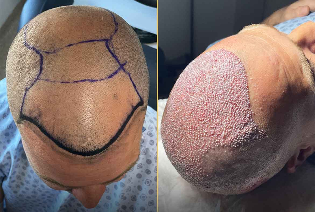 hair-transplantation-2